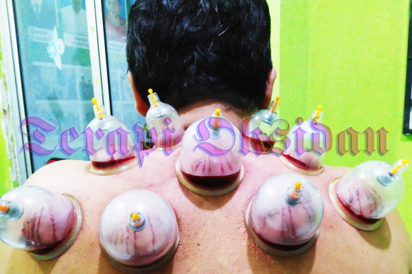 The dirty blood flow out as long as wet cupping therapy proces